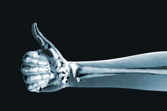 Röntgenové vyšetrenie na diagnostiku bolesti v kĺboch ​​prstov