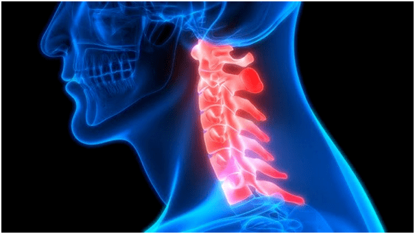 bolesť krku vedie k bolestiam chrbta