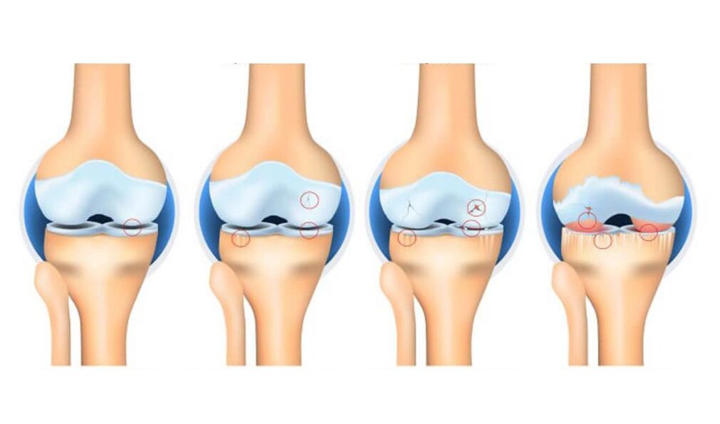 štádia artrózy kolenného kĺbu