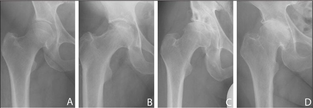 Etapy vývoja artrózy bedrového kĺbu na röntgenovom snímku