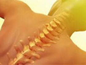 Osteochondróza - ochorenie chrbtice
