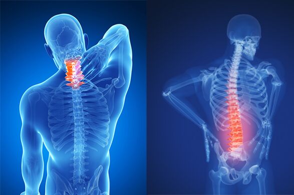 Osteochondróza krčnej a bedrovej chrbtice