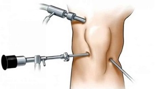 artroskopia pre artrózu kolenného kĺbu