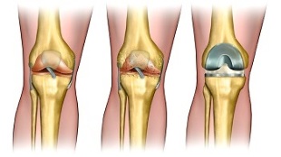 endoprotetika pre artrózu kolenného kĺbu