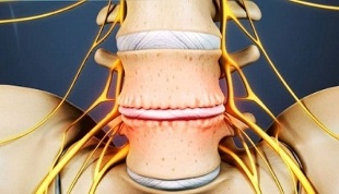 hlavné príznaky cervikálnej osteochondrózy